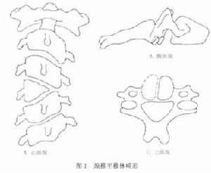 頸椎半椎體畸形