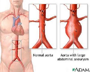 主動脈瘤