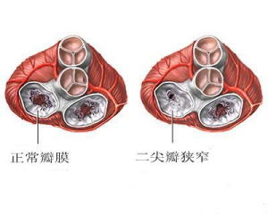 三尖瓣狹窄