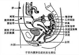 盆腔子宮內膜異位症