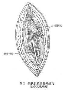 （圖）梨狀肌症候群