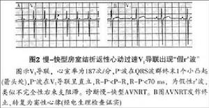 房室結雙徑路