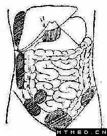 急性腹膜炎