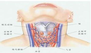 胸內甲狀腺瘤