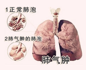 慢性阻塞性肺氣腫