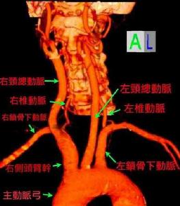 頸內動脈海綿竇外傷性瘺