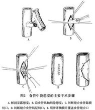 食管中段憩室