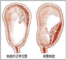 《產前出血》