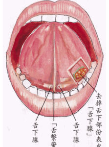 舌下腺囊腫