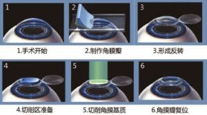 準分子手術